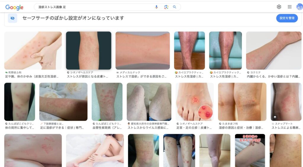 湿疹ストレス画像 足